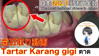 上尾の歯医者の歯周病治療。8年分の歯石取り動画　part２